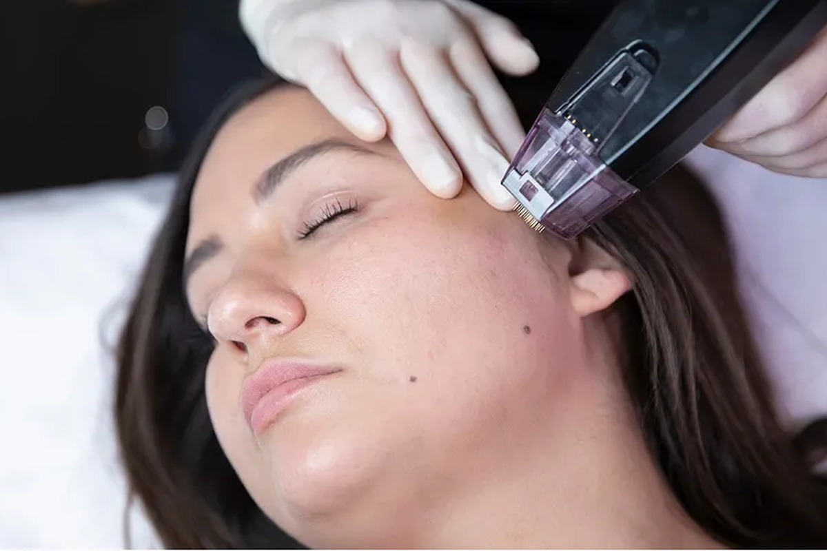 Morpheus8 RF Microneedling at Clear Skin Clinic Bradford
