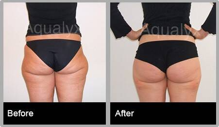 3image (004) Aqualyx Fat Dissolving Treatment