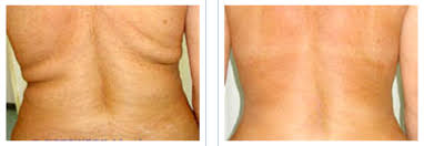 4image (004) Aqualyx Fat Dissolving Treatment