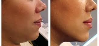 image (005) Aqualyx Fat Dissolving Treatment