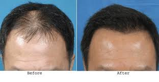 image Hair Loss Treatment